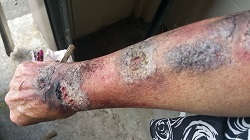 moulage burn